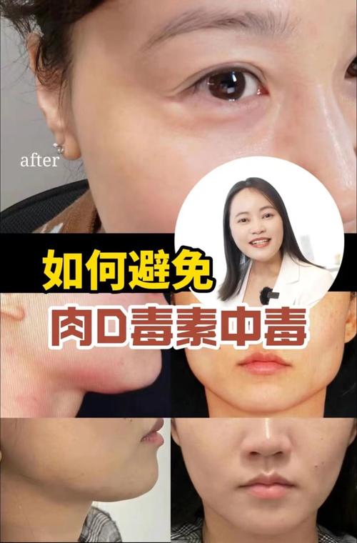 2人注射肉毒素中毒,注射肉毒素中毒症状